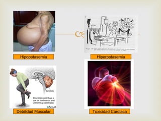 
 Hipopotasemia             Hiperpotasemia




Debilidad Muscular       Toxicidad Cardiaca
 