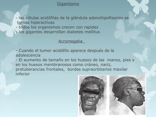 Gigantismo
- las células acidófilas de la glándula adenohipofisarias se
tornas hiperactivas
- todos los organismos crecen con rapidez
- los gigantes desarrollan diabetes mellitus
Acromegalia
- Cuando el tumor acidófilo aparece después de la
adolescencia
- El aumento de tamaño en los huesos de las manos, pies y
en los huesos membranosos como cráneo, nariz,
protuberancias frontales, bordes supraorbitarios maxilar
inferior
 