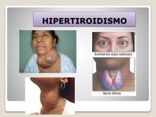 HIPERTIROIDISMO
 