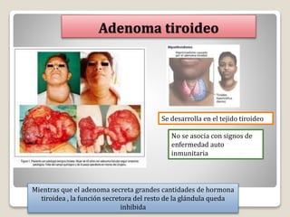 Adenoma tiroideo
Se desarrolla en el tejido tiroideo
No se asocia con signos de
enfermedad auto
inmunitaria
Mientras que el adenoma secreta grandes cantidades de hormona
tiroidea , la función secretora del resto de la glándula queda
inhibida
 