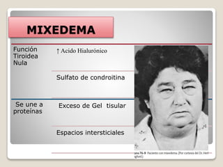MIXEDEMA
Función
Tiroidea
Nula
↑ Acido Hialurónico
Sulfato de condroitina
Se une a
proteínas
Exceso de Gel tisular
Espacios intersticiales
 