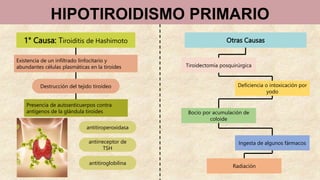 HIPOTIROIDISMO PRIMARIO
1° Causa: Tiroiditis de Hashimoto
Existencia de un infiltrado linfocitario y
abundantes células plasmáticas en la tiroides
Presencia de autoanticuerpos contra
antígenos de la glándula tiroides
Otras Causas
Tiroidectomía posquirúrgica
Deficiencia o intoxicación por
yodo
Bocio por acumulación de
coloide
Ingesta de algunos fármacos
Radiación
Destrucción del tejido tiroideo
antitiroglobilina
antitiroperoxidasa
antirreceptor de
TSH
 