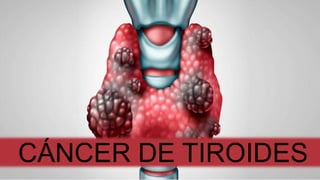 CÁNCER DE TIROIDES
 