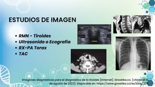 ESTUDIOS DE IMAGEN
RMN - Tiroides
Ultrasonido o Ecografía
RX-PA Torax
TAC
Imágenes diagnósticas para el diagnóstico de la tiroides [Internet]. Gnostika.co. [citado el 16
de agosto de 2023]. Disponible en: https://www.gnostika.co/es/blog/209
 