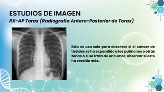 ESTUDIOS DE IMAGEN
RX-AP Torax (Radiografía Antero-Posterior de Torax)
Esta se usa solo para observar si el cancer de
tiroides se ha expandido a los pulmones o otras
zonas o si se trata de un tumor, observar si este
ha crecido más.
 