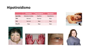 Hipotiroidismo
Primario Secundario Terciario
Qué falla Glándula tiroides Hipófisis Hipotálamo
TRH Normal Normal Baja
TSH Normal Baja Baja
T3 y T4 Baja Baja Baja
 