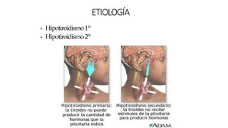 ▶ Hipotiroidismo1°
▶ Hipotiroidismo2°
ETIOLOGÍA
 