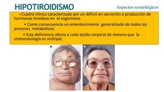 • Cuadro clínico caracterizado por un déficit en secreción o producción de
hormonas tiroideas en el organismo.
• Como consecuencia un enlentecimiento generalizado de todos los
procesos metabólicos.
• Esta deficiencia afecta a cada tejido corporal de manera que la
sintomatología es múltiple.
HIPOTIROIDISMO Aspectos semiológicos
 