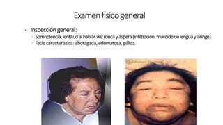 ▶ Inspección general:
◦ Somnolencia,lentitud alhablar,vozronca yáspera(infiltración mucoidedelenguaylaringe)
◦ Faciecaracterística: abotagada, edematosa, pálida.
Examenfísicogeneral
 