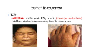 ▶ TCS:
◦ MIXEDEMA: tumefacción delTCS y delapiel (edemaque no deja fóvea).
Visibleprincipalmenteen cara, nuca ydorsode manos ypies.
Examenfísicogeneral
 
