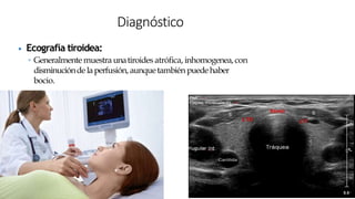 ▶ Ecografía tiroidea:
◦ Generalmente muestra unatiroides atrófica, inhomogenea,con
disminucióndelaperfusión, aunquetambién puedehaber
bocio.
Diagnóstico
 