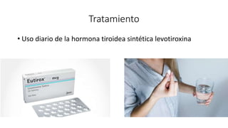 Tratamiento
• Uso diario de la hormona tiroidea sintética levotiroxina
 