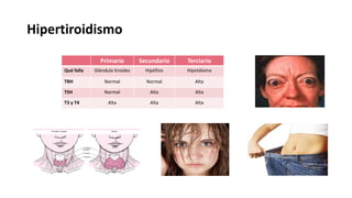 Hipertiroidismo
Primario Secundario Terciario
Qué falla Glándula tiroides Hipófisis Hipotálamo
TRH Normal Normal Alta
TSH Normal Alta Alta
T3 y T4 Alta Alta Alta
 