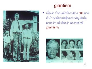 giantism
• เนื่องจากในวัยเด็กมีการสร้ าง GH มาก
  เกินไปจะมีผลกระตุ้นการเจริญเติบโต
  มากกว่าปกติ เรี ยกว่า สภาวะยักษ์
  (...