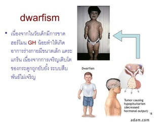 dwarfism
• เนื่องจากในวัยเด็กมีการขาด
  ฮอร์ โมน GH น้ อยทาให้ เกิด
  อาการร่างกายมีขนาดเล็ก แคระ
  แกร็น เนื่องจากการเจริ...