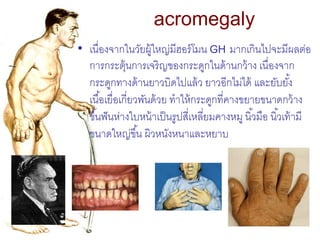 acromegaly
• เนื่องจากในวัยผู้ใหญ่มีฮอร์ โมน GH มากเกินไปจะมีผลต่อ
  การกระตุ้นการเจริญของกระดูกในด้ านกว้ าง เนื่องจาก
  ...