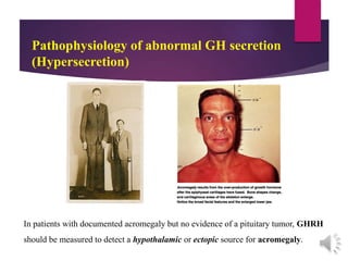 Pathophysiology of abnormal GH secretion
(Hypersecretion)
In patients with documented acromegaly but no evidence of a pituitary tumor, GHRH
should be measured to detect a hypothalamic or ectopic source for acromegaly.
 