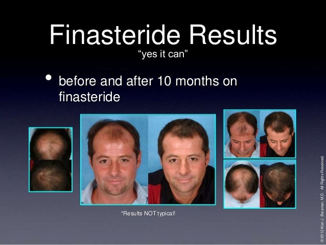 Propecia month by month results