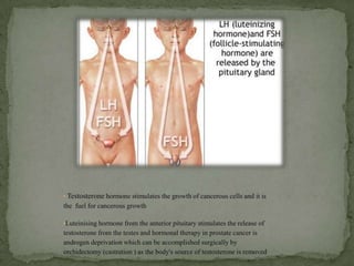 Testosterone hormone stimulates the growth of cancerous cells and it is the  fuel for cancerous growth