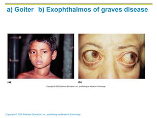 Copyright © 2006 Pearson Education, Inc., publishing as Benjamin Cummings
a) Goiter b) Exophthalmos of graves disease
 