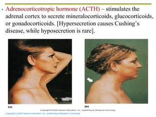 Copyright © 2006 Pearson Education, Inc., publishing as Benjamin Cummings
 Adrenocorticotropic hormone (ACTH) – stimulates the
adrenal cortex to secrete mineralocorticoids, glucocorticoids,
or gonadocorticoids. [Hypersecretion causes Cushing’s
disease, while hyposecretion is rare].
 