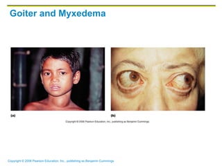 Copyright © 2006 Pearson Education, Inc., publishing as Benjamin Cummings
Goiter and Myxedema
 