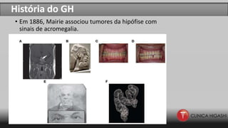 História do GH
• Em 1886, Mairie associou tumores da hipófise com
sinais de acromegalia.
AAAAA
 