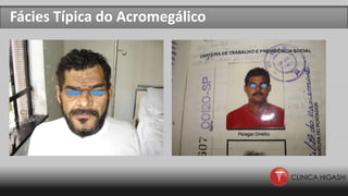Fácies Típica do Acromegálico
 