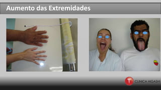Aumento das Extremidades
 
