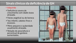 Sinais clínicos da deficiência de GHSinaisclínicosdadeficiênciadeGH
• Adquirida
Deficiência severa de
crescimento com idade óssea
atrasada.
Fácies angelical ou de boneca
Voz infantil, cabelos finos e
escassos.
Pênis pequeno e puberdade
usualmente atrasada.
Relação de peso/altura e
percentual de gordura
aumentados.
 