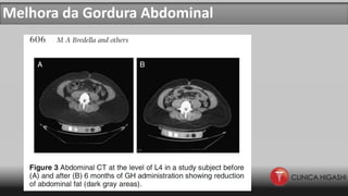 Melhora da Gordura Abdominal
 