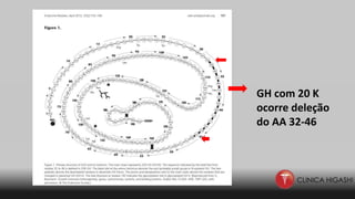 GH com 20 K
ocorre deleção
do AA 32-46
 