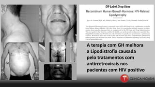 A terapia com GH melhora
a Lipodistrofia causada
pelo tratamentos com
antirretrovirais nos
pacientes com HIV positivo
 