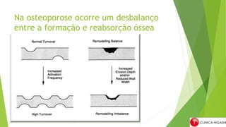 Na osteoporose ocorre um desbalanço
entre a formação e reabsorção óssea
 