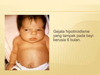 Gejala hipotiroidisme
yang tampak pada bayi
berusia 6 bulan.
 