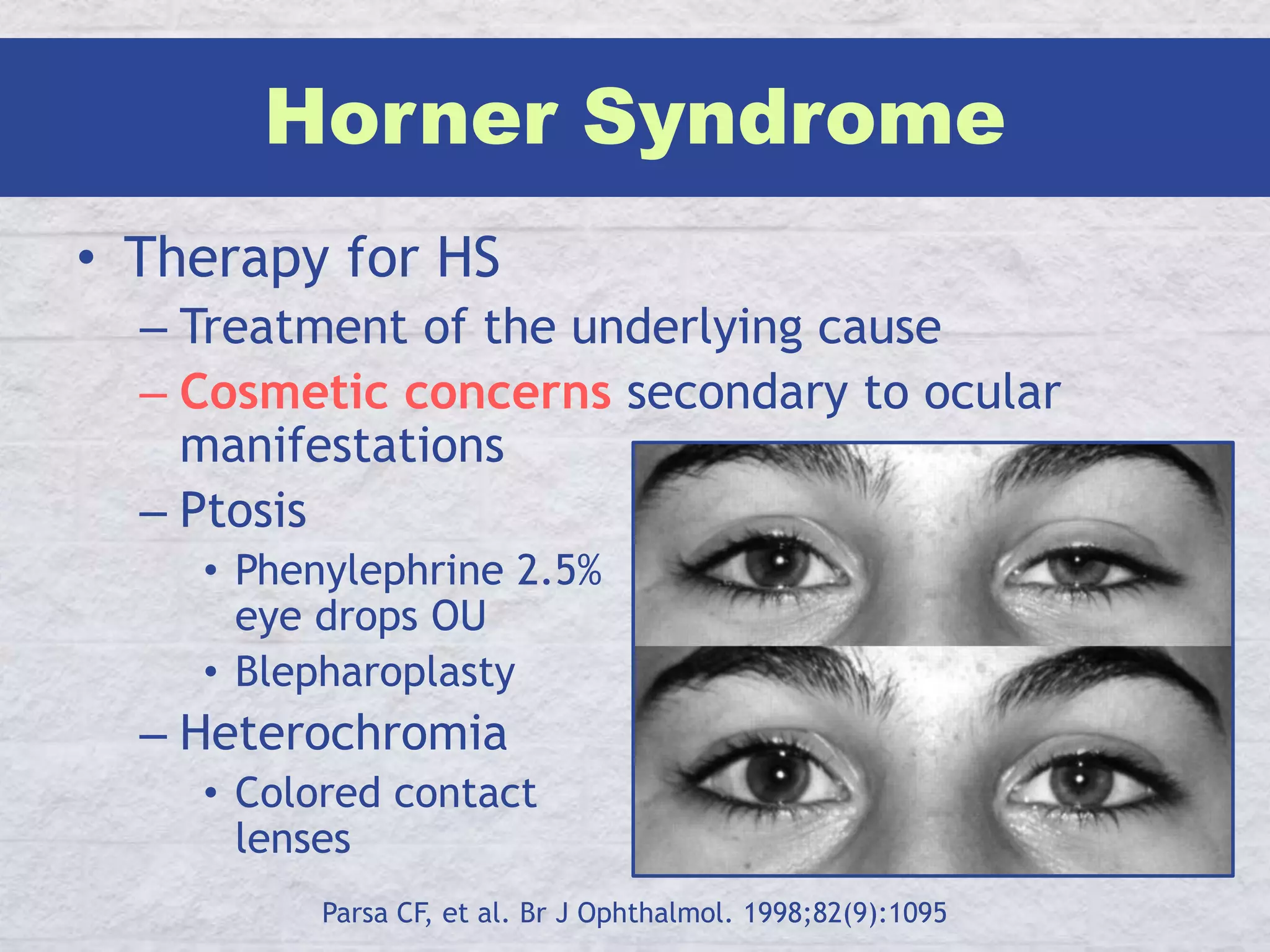 Horner Syndrome PPTX