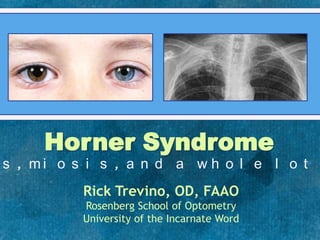Horner Syndrome
Ptosis, miosis, and a whole lot more!
Rick Trevino, OD, FAAO
Rosenberg School of Optometry
University of the Incarnate Word
 