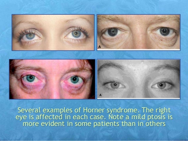 Horner Syndrome Horner Syndrome