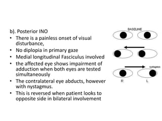 Horner's syndrome and Internuclear ophthalmoplegia | PPTX