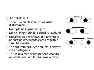 Horner's syndrome and Internuclear ophthalmoplegia | PPT