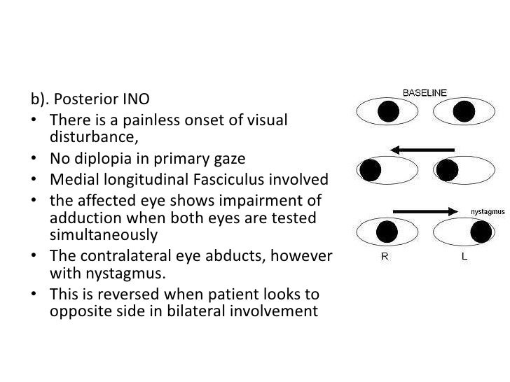 Horner's syndrome and Internuclear ophthalmoplegia
