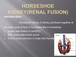 Understanding Horseshoe Kidney