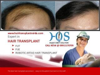 www.hairtransplantnoida.com
CALL NOW @ 09911170709
 