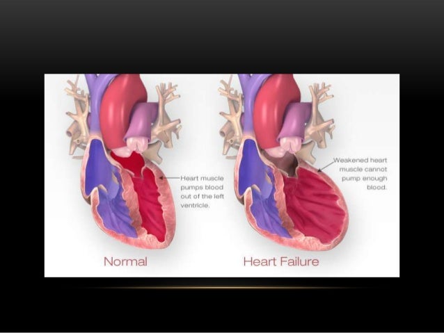 chf end stage stages of failure search results canada news iniberita link chf end stage stages of failure search results canada news iniberita link