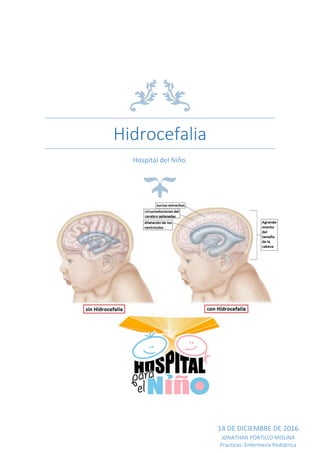 Hidrocefalia
Hospital del Niño.
14 DE DICIEMBRE DE 2016
JONATHAN PORTILLO MOLINA
Practicas: Enfermería Pediátrica
 