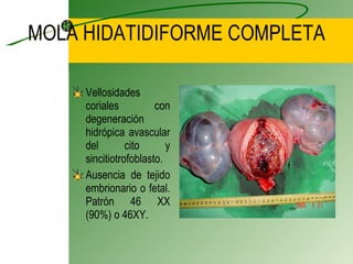 MOLA HIDATIDIFORME COMPLETA Vellosidades coriales con degeneración hidrópica avascular del cito y sincitiotrofoblasto.  Ausencia de tejido embrionario o fetal. Patrón 46 XX (90%) o 46XY. 