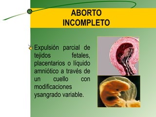 ABORTO INCOMPLETO Expulsión parcial de tejidos fetales, placentarios o líquido  amniótico a través de un cuello con modificaciones y sangrado variable. 