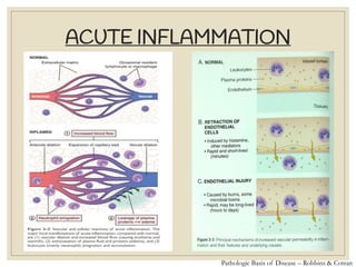 ACUTE INFLAMMATION
Pathologic Basis of Disease – Robbins & Cotran
 