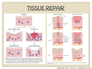 TISSUE REPAIR
Pathologic Basis of Disease – Robbins & Cotran
 