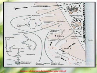 15
Courtesy : clinical periodontology,Carranza 10 th ed
 